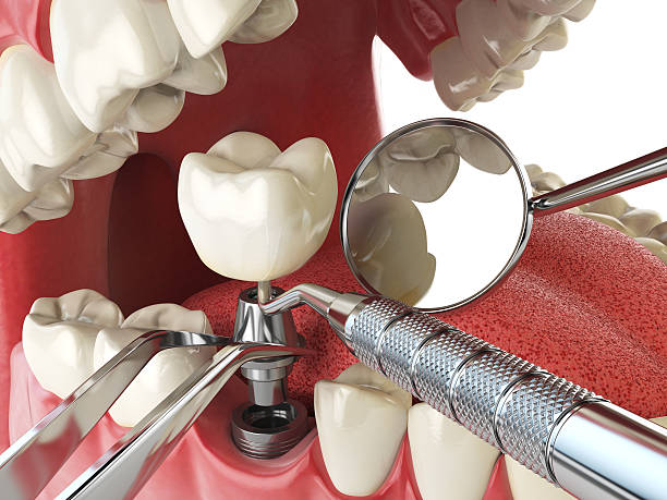 Best Emergency Dental Extractions in Thermalito, CA